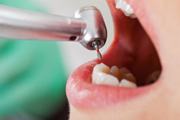 Best Emergency Wisdom Tooth Extraction in Pis, AR
